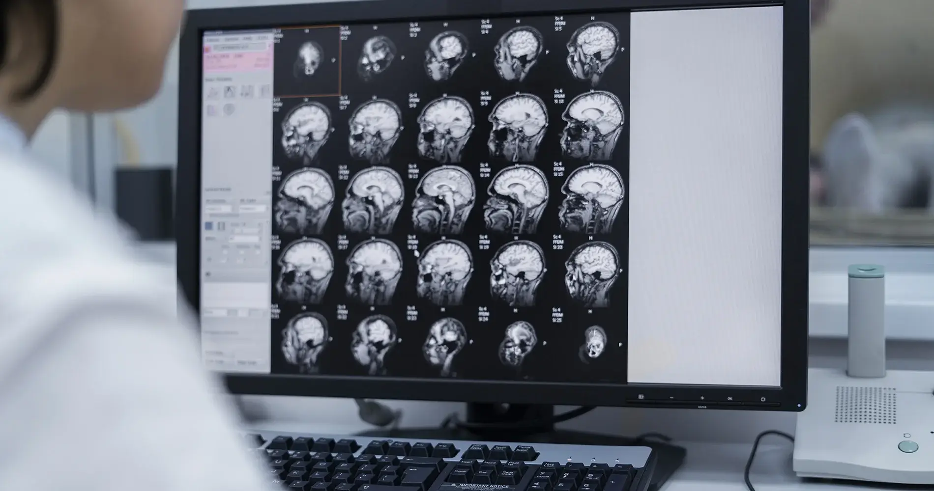 ام ار ای در تشخیص ام اس - اصلینو