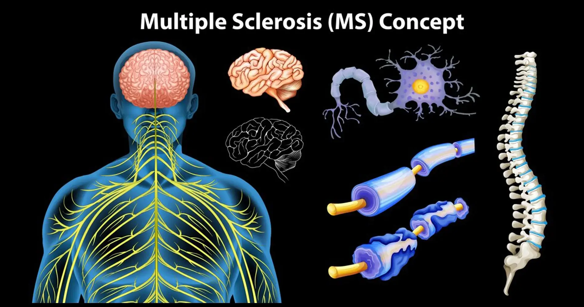 ام اس چیست و درمان آن - اصلینو